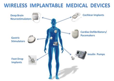 No Batteries Here: New Implants Can Charge Through Your 